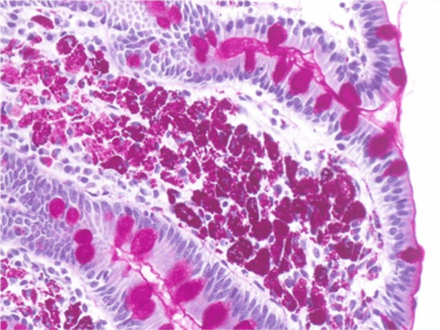 <p>Define Condition:</p><p>Caused by T. whipplei (gram-positive bacillus)</p><p>-Sx/PE:</p><p>&gt; Chronic (Intermittent) Diarrhea (Diarrhea = Watery &amp; Steatorrhea) + Colicky Abdominal Pain</p><p>&gt; Gross GI Bleeding</p><p>&gt; Malabsorption</p><p>&gt; Wt Loss</p><p>&gt; CNS Issues</p><p>&gt; Derm Issues</p><p>&gt; Pulm Issues</p><p>&gt; Cardiac Issues</p><p>-Dx: EGD w/ Small Bowel Bx</p><p>&gt; Accumulation of macrophages in lamina propria; PAS (+)</p><p>-Tx: Abx after C &amp; S</p>