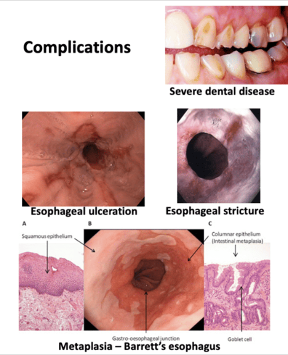 <p>Complications of this GI disease include:</p><p>- Severe dental disease</p><p>- Esophageal ulceration</p><p>- Esophageal stricture</p><p>- Barrett's esophagus</p>