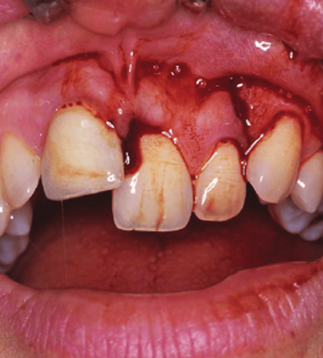 <p>•Typically involves mobile segments of two or more teeth</p><p>•Occlusal changes and lacerations common</p><p>•May extend to maxilla</p>