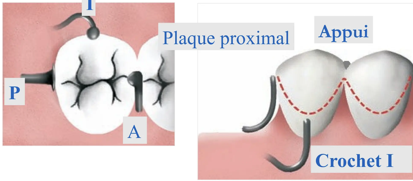 <p><strong>Descriptions : </strong></p><ul><li><p>1 taquet occlusal en mésial </p></li><li><p>1 plaque de guidage sur la face distale dans l’angle DL </p></li><li><p>1 bras en forme de “i” sur la partie mésiale de la face vestibulaire </p></li></ul><p></p><p><strong>Indication: </strong></p><ul><li><p>Édentement postérieur libre (si dent bordant l’édentemetn est une canine) </p></li><li><p>peu retentif </p></li></ul><p></p>