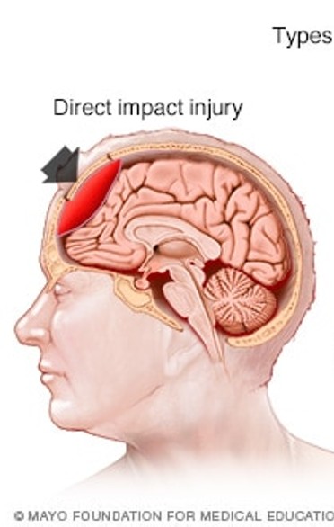 <p>direct blow to the head after contact with an external object or fall, penetration injury from weapon, collision of brain with inner parts of the skull </p>