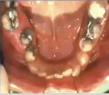 <p>What is the treatment of chondrosarcoma?</p>
