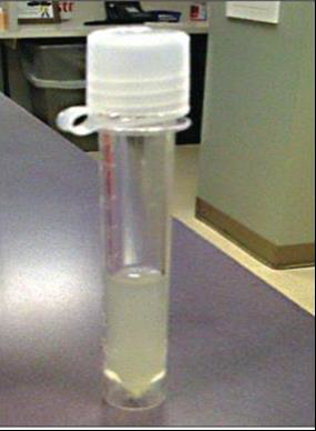 <p><strong>This is a CSF sample withdrawn from a suspected case of <em>Naegleria fowleri</em> infection:</strong></p><p><strong>Comment on its physical appearance.</strong></p><ul><li><p><strong>Turbid.</strong></p></li></ul><div data-type="horizontalRule"><hr></div><p><strong>Comment on the CSF diagnostic criteria in this infection, and identify the diagnostic stage.</strong></p><ul><li><p>CSF is <strong>purulent, bloody, and neutrophilic</strong>, with <strong>high protein content</strong> and <strong>reduced glucose concentration.</strong></p></li><li><p><strong>Motile trophozoites</strong> are the <strong>diagnostic stage.</strong></p></li></ul><div data-type="horizontalRule"><hr></div><p><strong>Name two stains used to stain CSF smears in this infection.</strong></p><ul><li><p><strong>Periodic acid–Schiff (PAS)</strong></p></li><li><p><strong>Giemsa</strong>, <strong>Wright</strong>, or <strong>Wright–Giemsa</strong> stain</p></li></ul><div data-type="horizontalRule"><hr></div><p><strong>Identify blood examination findings in this infection.</strong></p><ul><li><p><strong>Polymorphonuclear leukocytosis up to 25,000 cells/mm³</strong> with a predominance of <strong>neutrophils.</strong></p></li></ul><p></p>