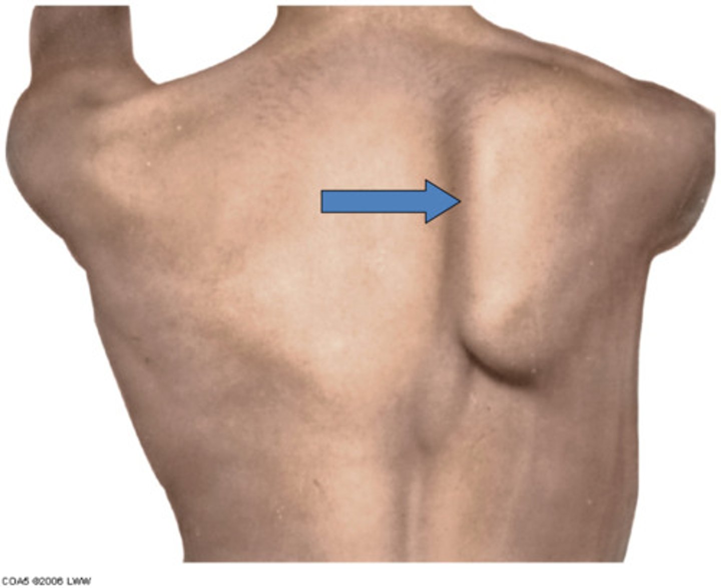 <p>what causes a winged scapula?</p>
