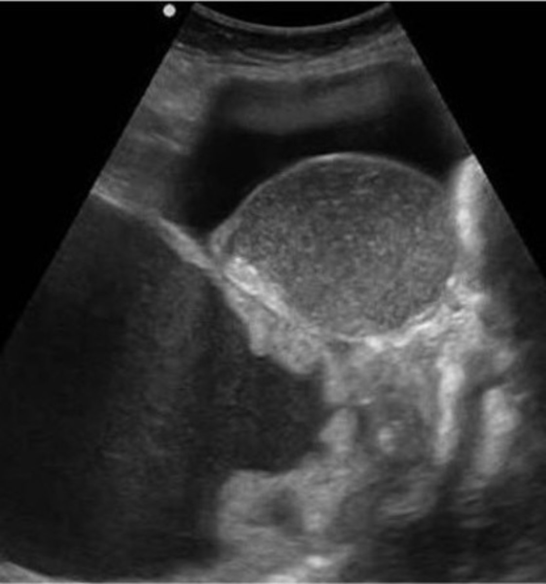 <p>ascites</p>