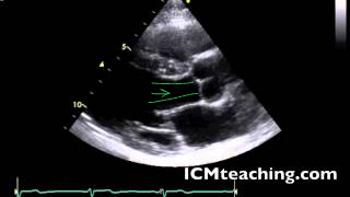 To the left of the aortic valve.