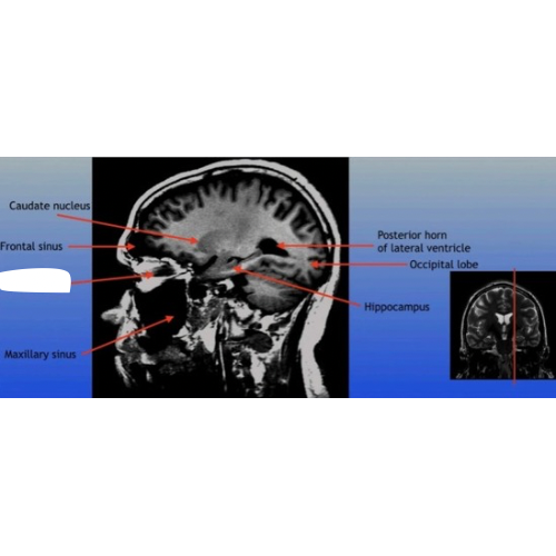 <p>The bundle of nerve fibers that transmits visual information from the retina to the brain. It plays a crucial role in the sense of sight. </p>