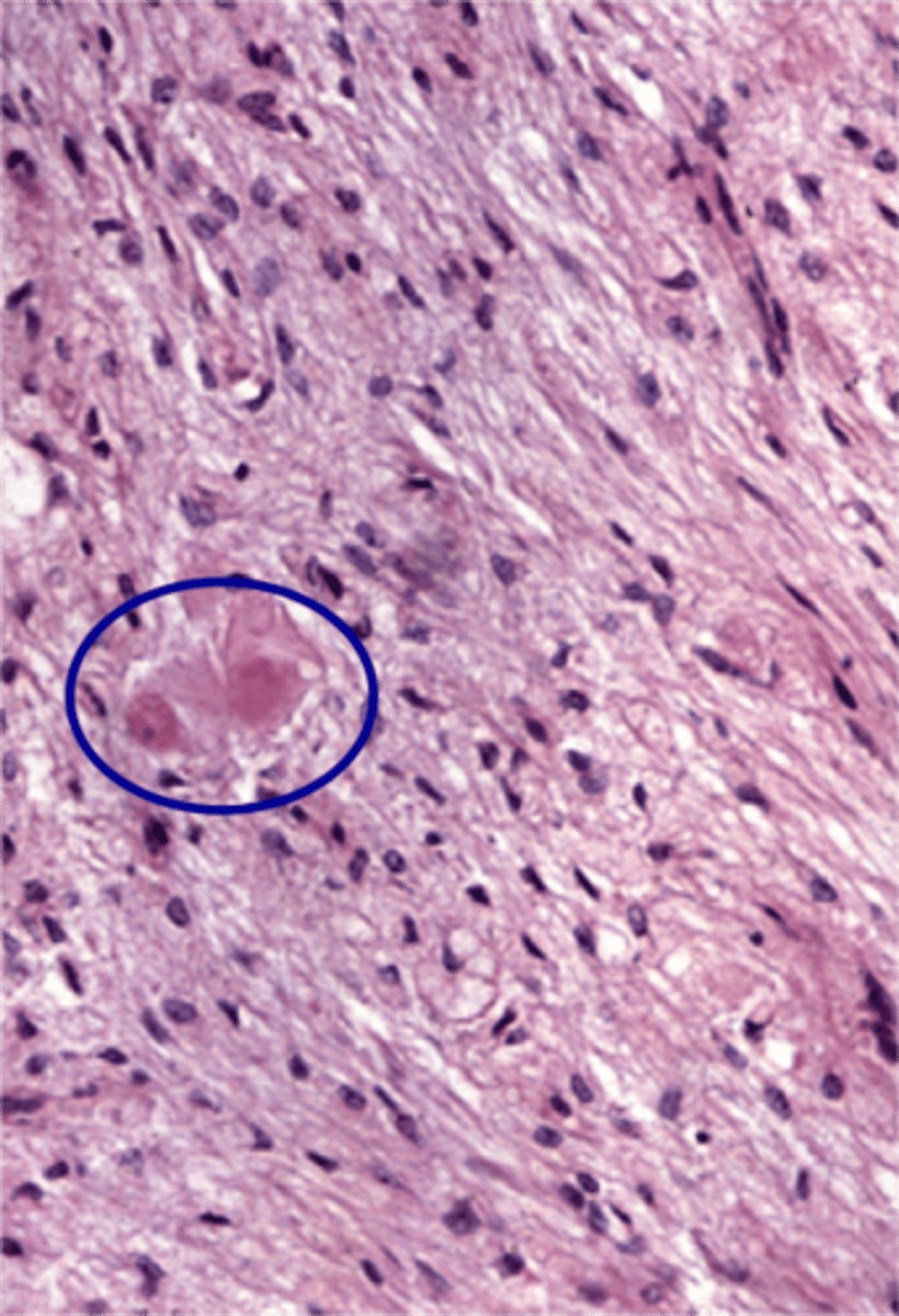 <p>eosinophilic neurosecretory bodies in the terminal ends of axons in the pars nervosa</p><p>-contain granules of ADH or oxytocin bound to neurophysin I or II proteins--&gt; protein cleaved when stimulated</p>
