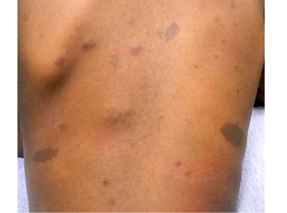 <p>multi system genetic disorder most notably characterized by <strong>cafe au lait spots</strong> and neurofibromas</p><p>autosomal dominant inheritance</p>