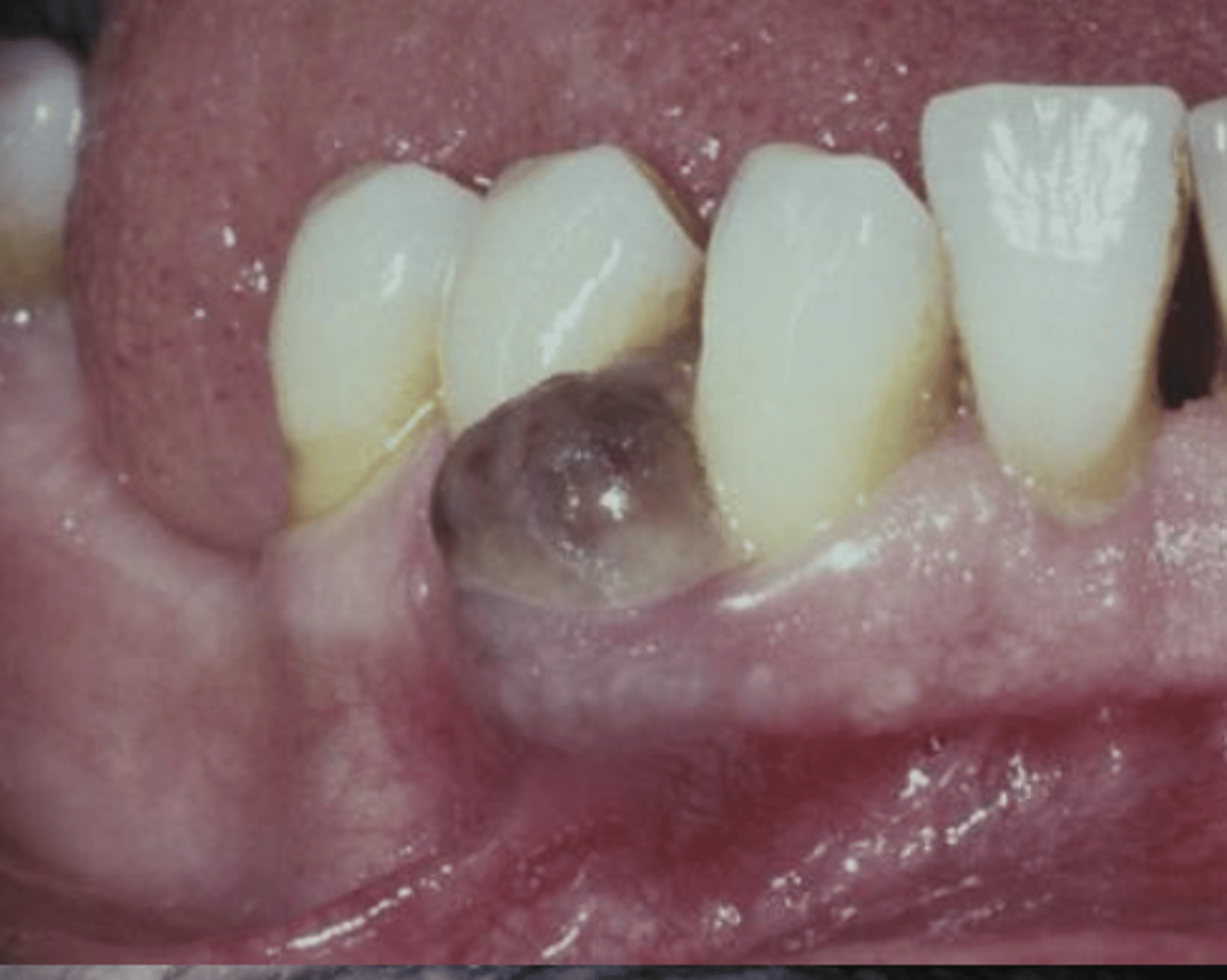 <p>Gingiva is most common site** (mimic 4 P's)</p><p>Resembles hyperplastic/reactive growths</p><p>Can be ulcerated</p><p>Histology matches PRIMARY tumor</p>