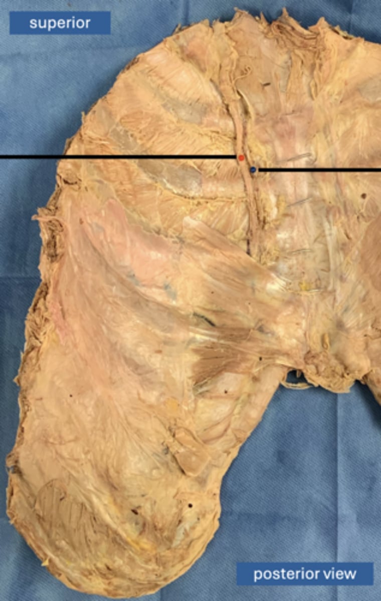 <p>vein</p>