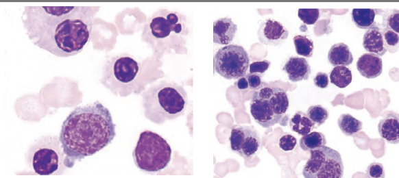 <p>which FAB classification is associated with the following information?</p><ul><li><p>&gt;80% of cells are of erythroid origin </p></li><li><p>&gt;30% are pro-normoblasts </p></li><li><p>dysplastic changes in erythroid precursors such as multinucleation (N:C asynchrony, vacuolization)</p></li><li><p>&gt;50% nRBCs on PBS</p></li><li><p>ringed sideroblasts, HJ bodies </p></li><li><p>aggressive and rapid clinical course </p></li></ul><p></p>