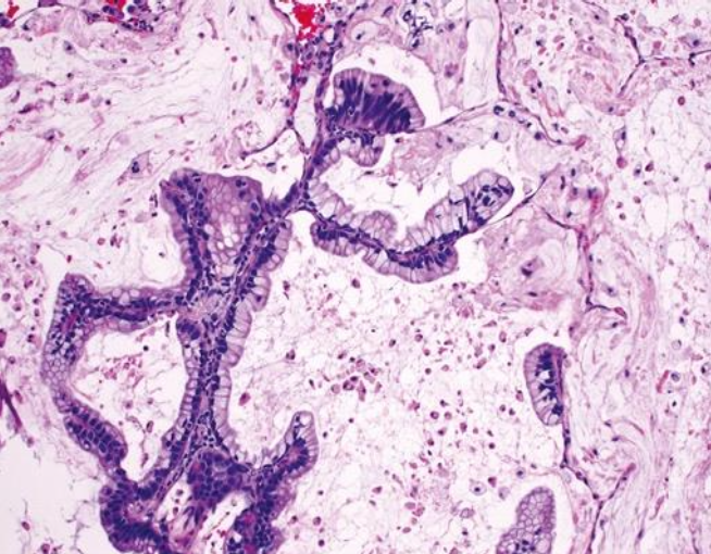 <p>Adenocarcinoma in situ</p>