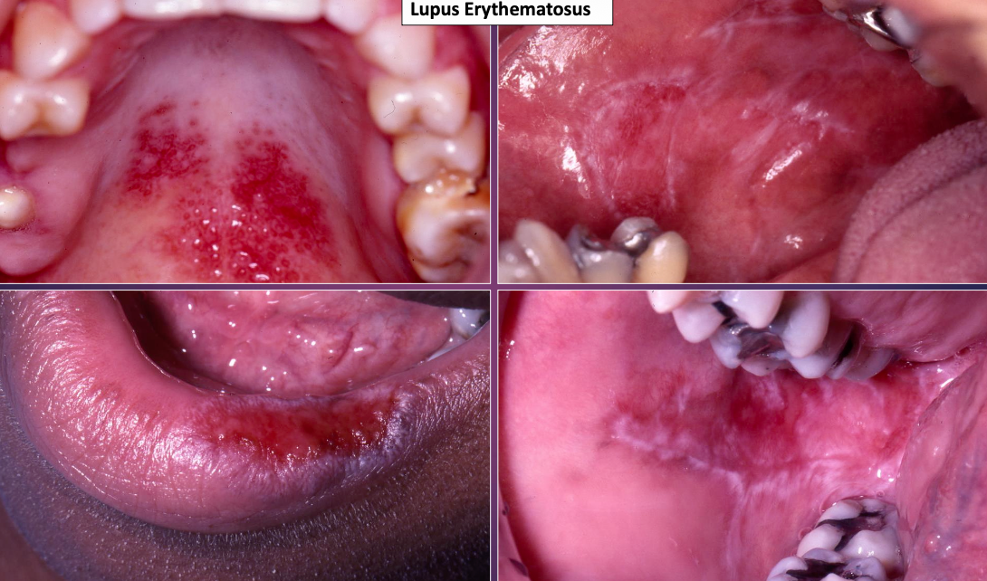 <p>In which gender does Systemic Lupus Erythematosus primarily show up in? What age?</p>