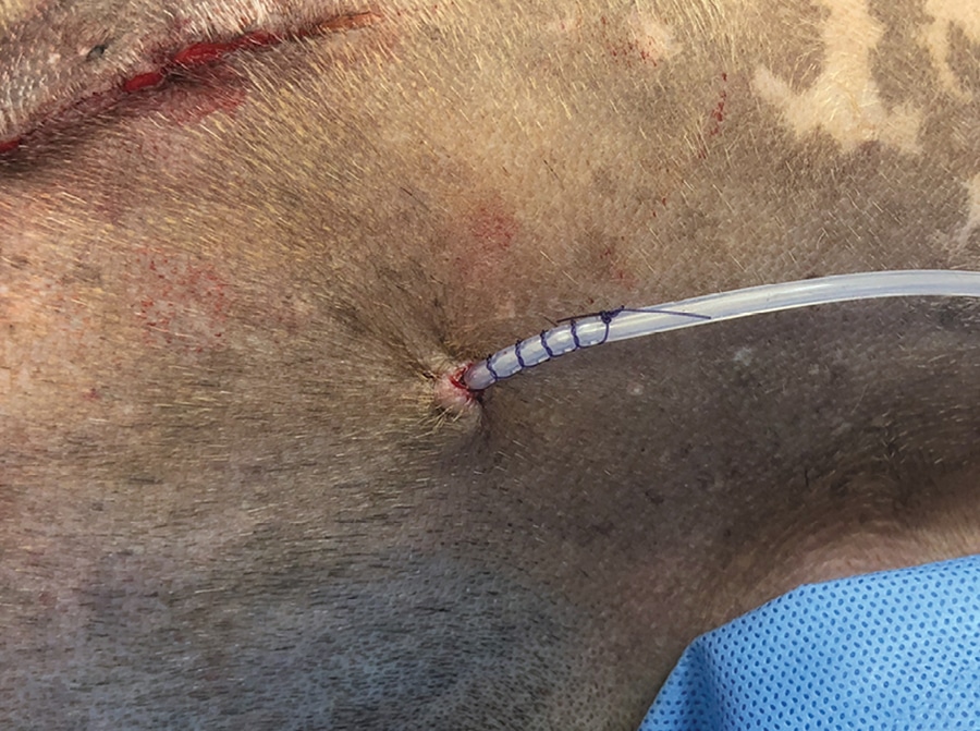 <p>tube used to drain fluid from inside body</p>