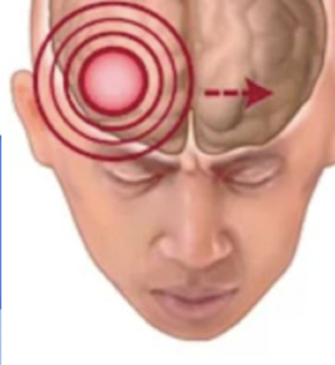 <p>- Think: "migrates."</p><p>- Rapid Onset: 1-2 hours</p><p>- Time it Lasts: 4-72 hours</p><p>- Pain Type: throbbing and pulsating</p><p>- Sx: nausea, vomiting, photophobia</p><p>- Tx: rest, NSAIDS, and non-pharm</p><p>- Causes: A LOT</p>