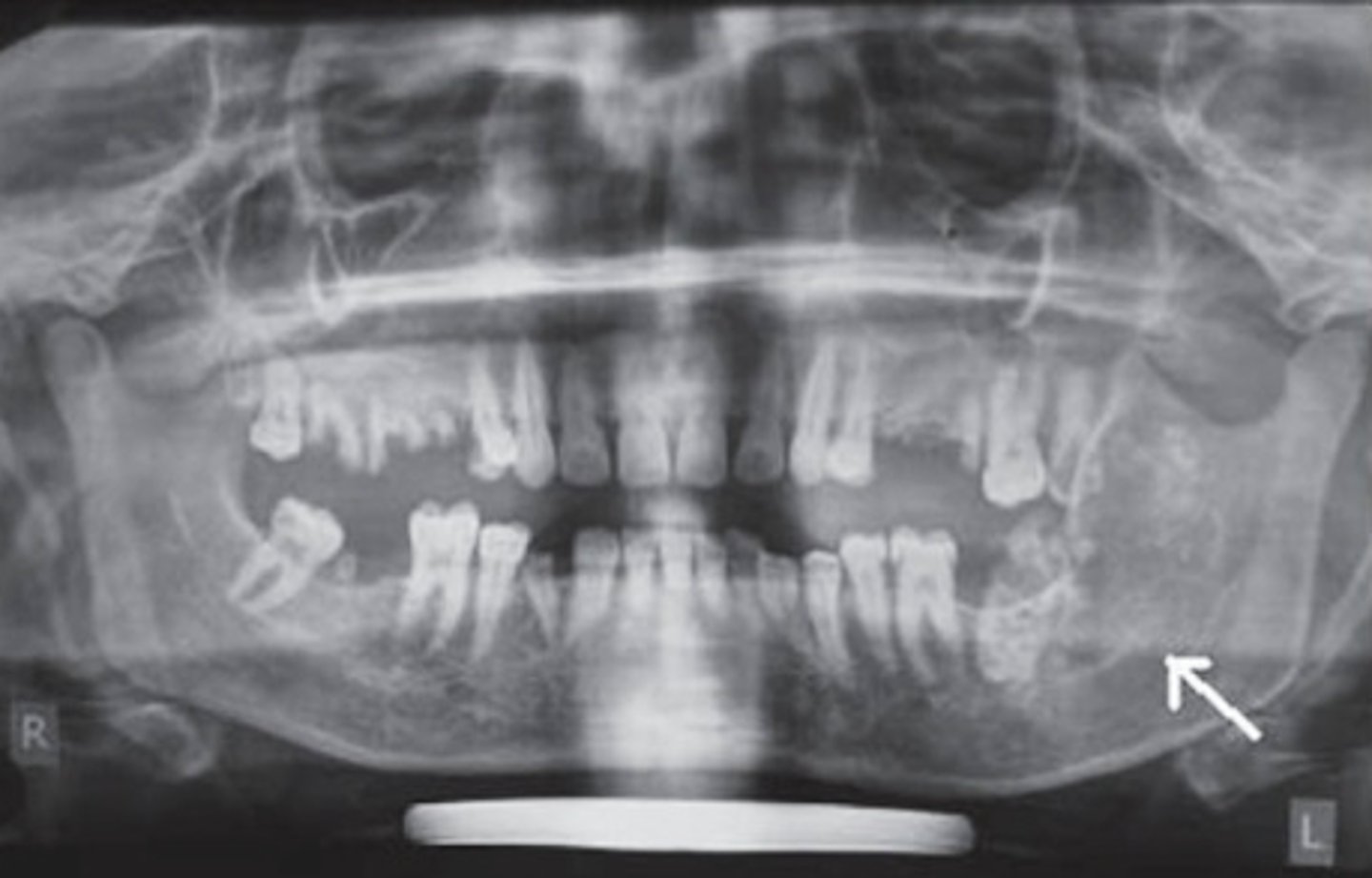 <p>ID the pathology:</p><p>-Lesion in left ramus, body</p><p>-Ill defined periphery</p><p>-Calcifications noted</p><p>-Expansion of ramus</p><p>-IAN destroyed</p>