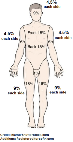 <p>what is the “rule of nines”?</p>