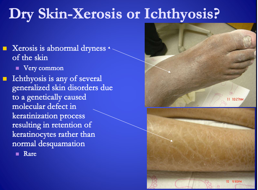 <p><span><strong>[...]</strong></span>&nbsp;</p><ul><li><p>any of several generalized skin disorders due to a genetically caused molecular defect in keratinization process <strong>resulting in retention of keratinocytes rather than normal desquamation</strong>&nbsp;</p></li></ul><p></p>