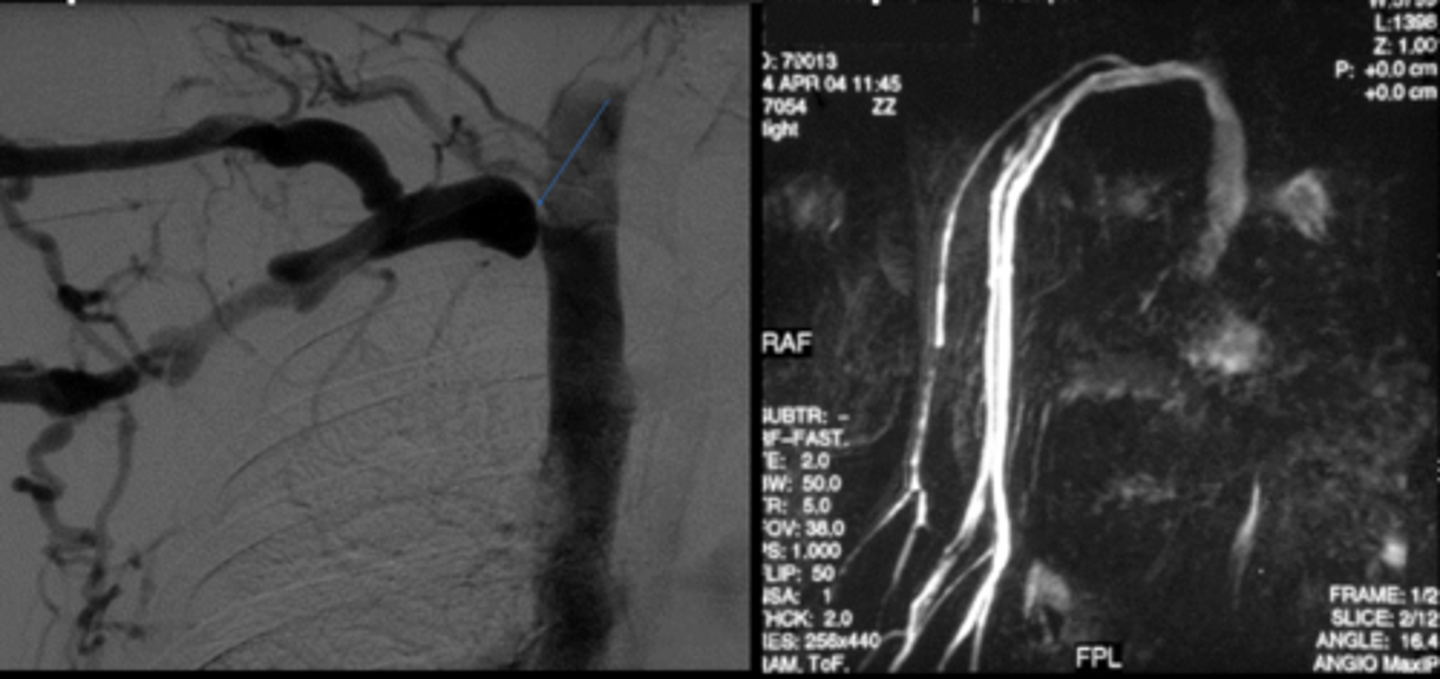 <p>Venography</p><p>Enhanced MR Venogram</p>