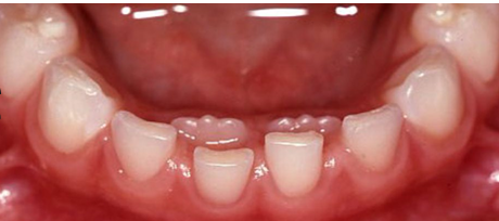 <p>-see especially in mandibular teeth (most commonly anterior)</p><p>-assess mobility of primary teeth, encourage child to wiggle, watch and wait approach</p><p>-more concerning in maxilla → can lock teeth into an anterior crossbite due to lack of tongue force/strength pushing into occlusion</p>