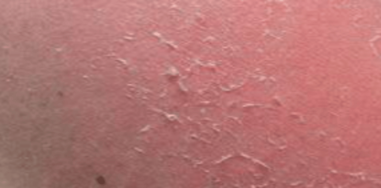 <p>- involves only the epidermis</p><p>- does not blister</p><p>- painful, dry, red (erythema) => cap refill normal</p><p>- healing time: 1 week</p>