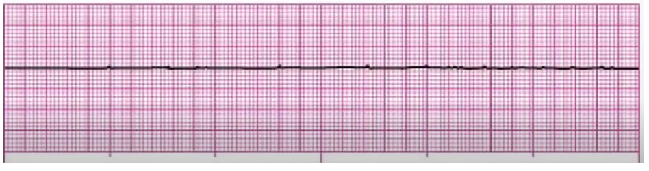 <p>CPR, epi</p><p>Hs and Ts: hypovolemia, hypoxia, hydrogen ions, hypothermia, hyper/hypokalemia, hypoglycemia, toxins (drug overdose), tachycardia, tamponade, tension pneumo, thrombosis (MI/PE), trauma</p><p>no CO, no perfusion</p>