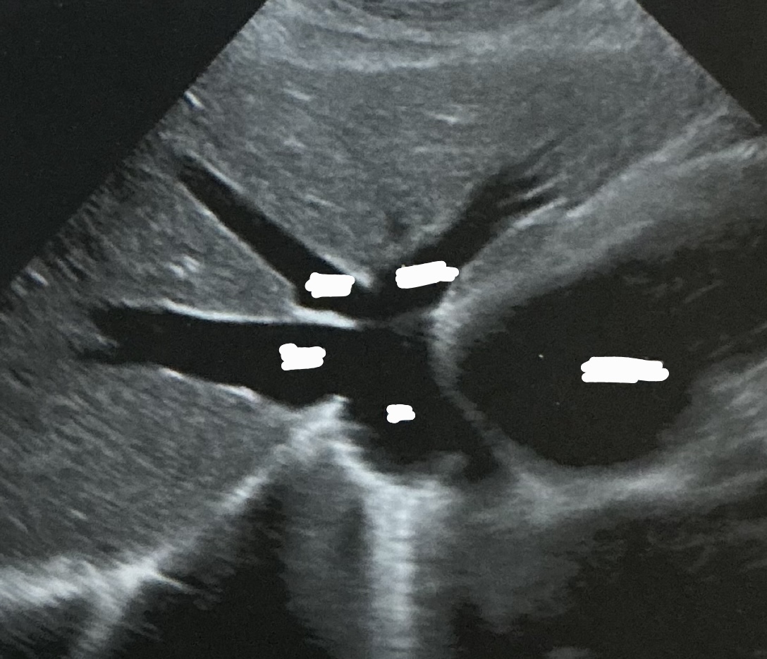 <p>Label this picture</p><ul><li><p>what sign is it depicting&nbsp;</p></li><li><p>Why does this happen?</p></li><li><p>What sign does the hepatic veins normally depict?</p></li></ul><p></p>