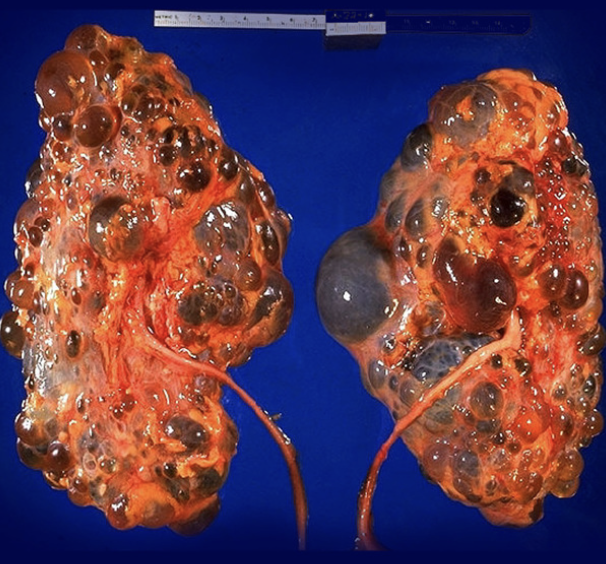 <p>The most common inherited kidney disease that is characterized by cyst growth on the kidneys, damaging the parenchyma and disturbing renal function</p>