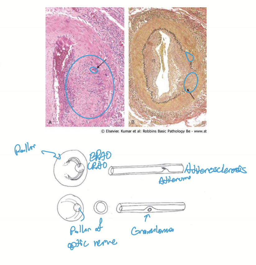 <ol><li><p>Granulomatous inflammation in the tunica intima and tunica media disrupts the internal elastic membrane</p></li><li><p>Inflammation causes swelling of vessel wall</p></li><li><p>Lumen narrows</p></li><li><p>Vessel can become occluded if the lumen causes pressure to fall below the critical closing pressure</p></li><li><p>Ischemia of downstream tissues</p></li></ol><p></p>