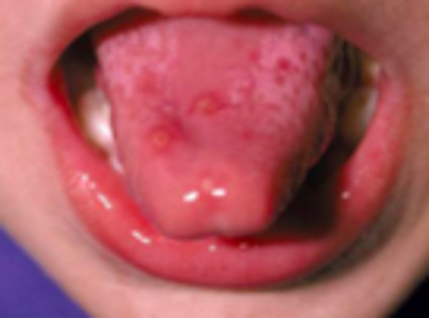 <p>Exanthems:</p><p>Overview:</p><p>- Viral illness</p><p>- Presents as oral enanthem and macular, maculopapular, or vesicular rash of hands and feet (including palms &amp; soles)</p><p>- Caused by coxsackievirus</p><p>- Transmitted person→person or fecal–oral route</p><p>- Incubation period: 3-5 days (sometimes 2 days, sometimes 7)</p>