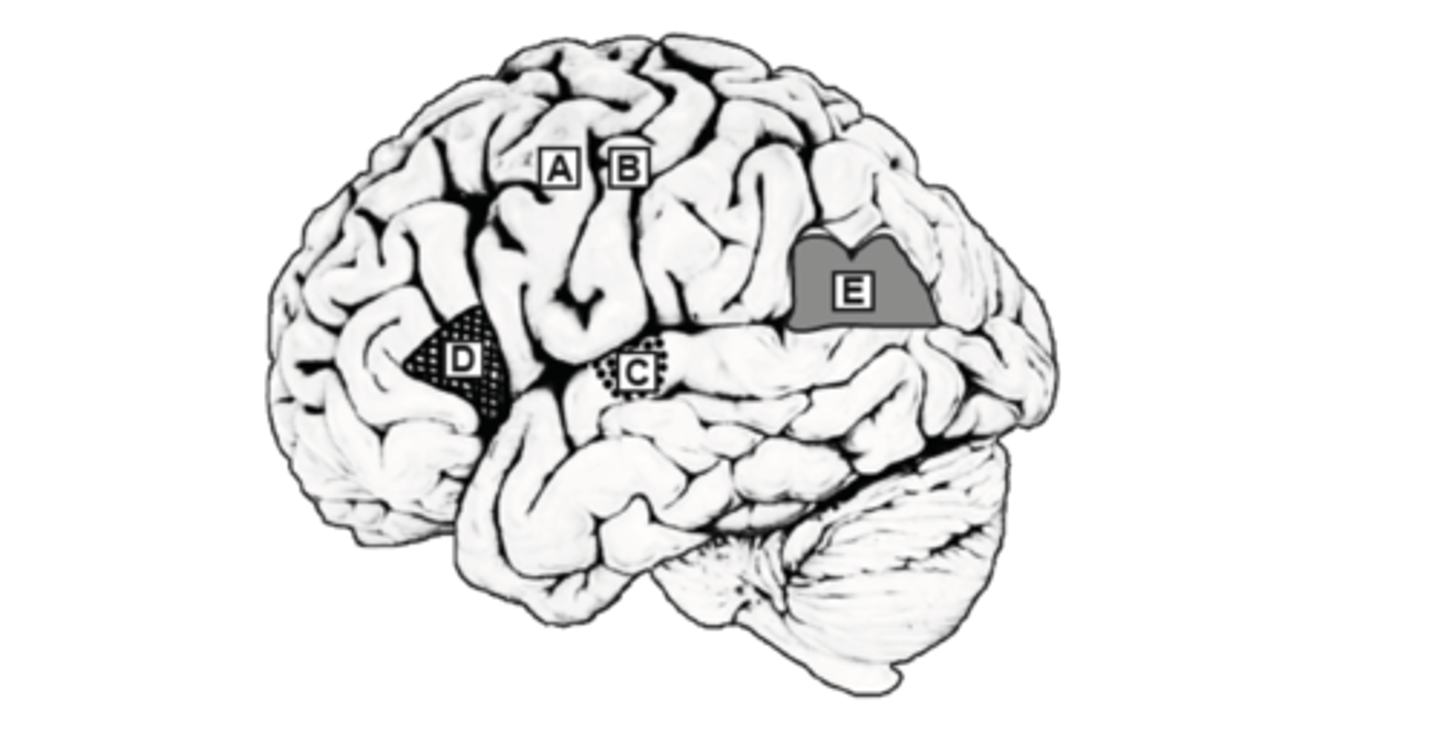 <p>A - Difficulty with movement of the right arm - specifically, spastic paralysis</p><p>B - No sensation from the right arm region</p><p>C - Deafness (loss of hearing)</p><p>D - Motor (non-fluent) aphasia - inability to coordinate muscular movements for generating speech</p><p>E - Inability to understand reading and writing</p>