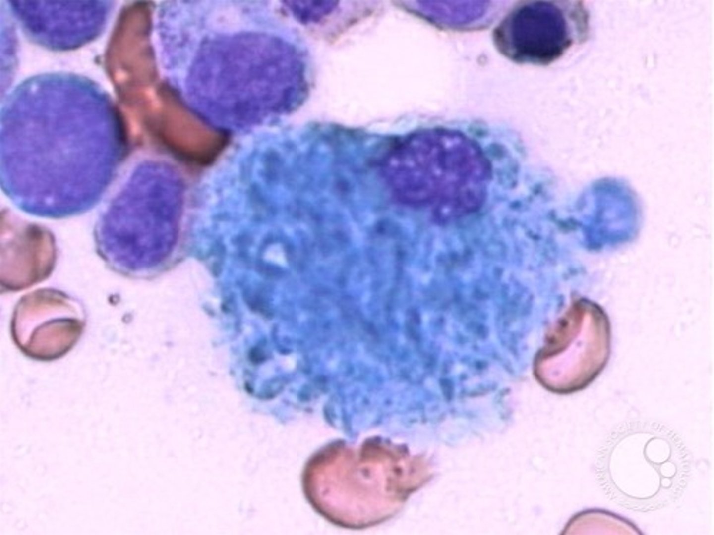 <p>Sea blue macrophages in liver, spleen, and bone marrow<br>-seen in lipid metabolism disorders</p>