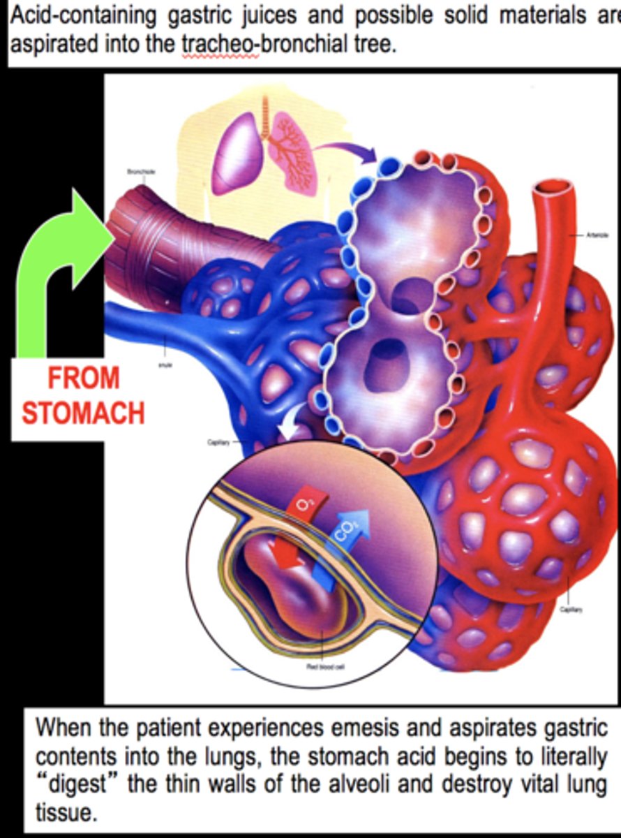 <p>definition: entry of stomach contents into lungs</p><p>signs: pneumonitis (lung tissue inflammation), rales (small clicking, bubbling, rattling sounds in lungs), tachycardia, dyspnea (difficulty breathing)</p><p>prevention: NPO guidelines, protective reflexes</p>