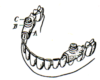 <p>U-shaped clips on teeth</p>