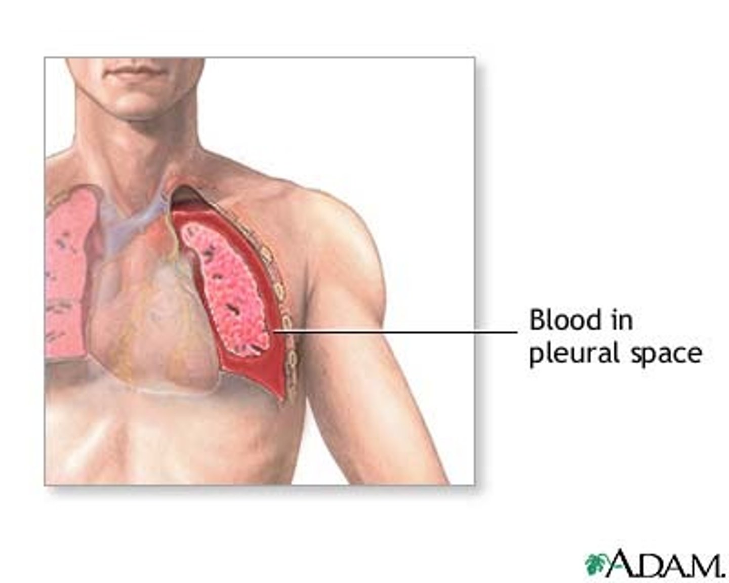 <p>A collection of blood in the space between the chest wall and the lung (pleural cavity)</p>