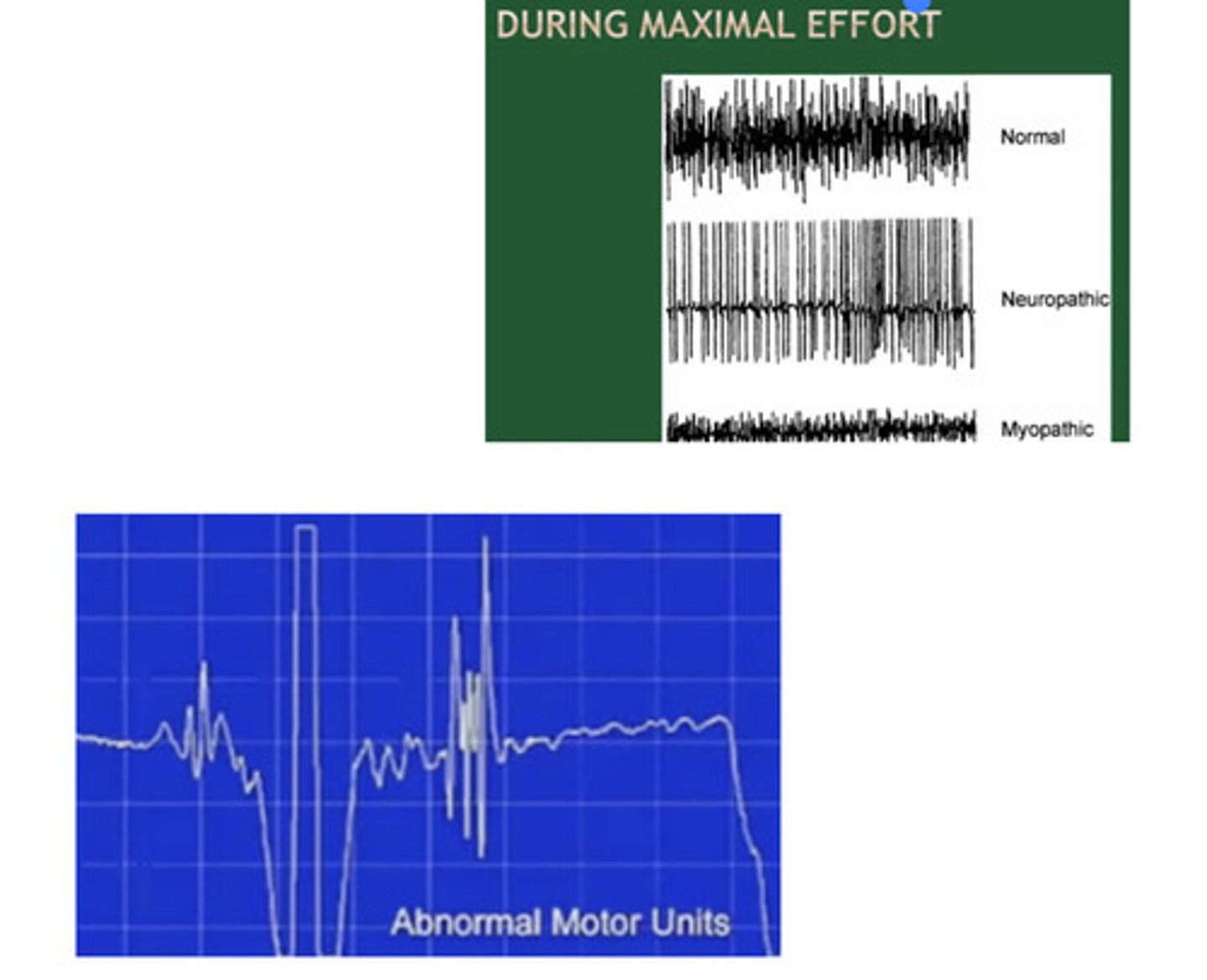 <p>1. Needle Insertion: Prolonged or absent insertional activity</p><p>2. At Rest: Spontaneous potential</p><p>+ sharp waves</p><p>Fibrillation potentials</p><p>Fasciculation potentials</p><p>3. Minimal Effort: Abnormal waveforms, GIANT MUP</p><p>4. Maximal Effort: Myopathic/ neuropathic patterns</p>