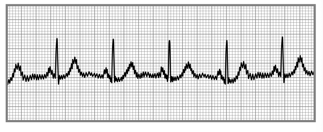 <p>an artifact caused by any electronic device near or on the patient shown by small uniform spikes</p>