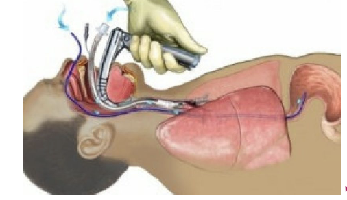 <ul><li><p>endotracheal intubation may cause damage to the structures within the larynx, producing an inflammatory response - laryngitis</p><ul><li><p>hearsness and pain during speech </p></li></ul></li></ul><p></p>