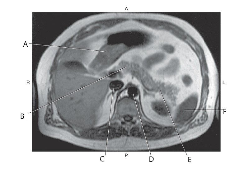 <p>Which arrow is pointing on pancreas body?</p>
