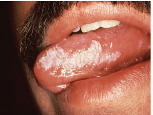 <p>hyperkeratosis occurring in response to chronic irritation that can sometimes represent dysplasia or early invasive squamous cell carcinoma</p><p>-commonly presents as fixed white lesions on mucosal surface </p>