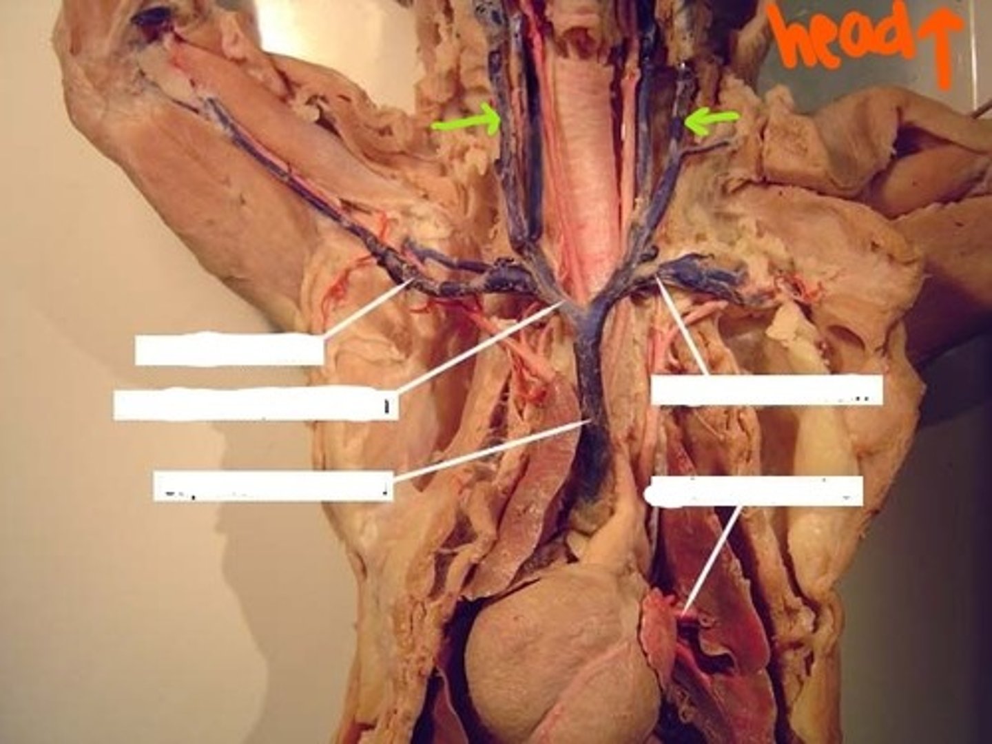 <p>identify this vein</p>
