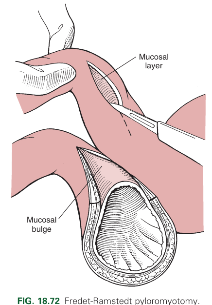 <p>Performed by making longitudinal incision through serosa &amp; muscularis of ventral pylorus. Only the serosa and muscularis should be incised, not mucosa (partial thickness incision)</p>
