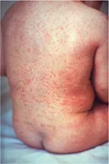 <p>Rubella (Measles)</p>