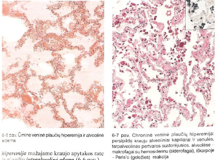 <p>Ūminis - ūminė <strong>veninė hiperemija mažajame kraujo apytakos rate ir plaučiu intraalveolinė edema, padidėjusi plaučių masė. </strong>Transudatas kaupiasi perivaskuliariai ir intersticiniame audinyje - tarpląstelinėse pertvarose, alveolių ertmėse - edeminiu eksudatu <strong>hiperemiškos kraujagyslės</strong></p><p></p>