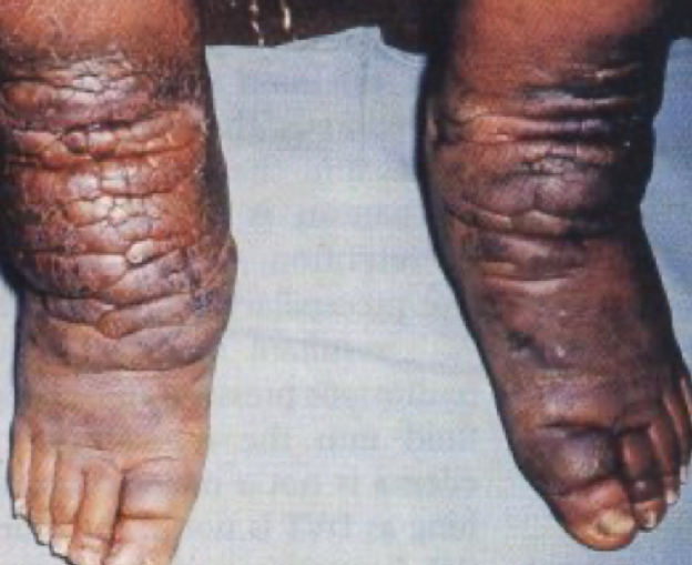 <p>a parasitic disease caused by microscopic, thread-like worms</p>