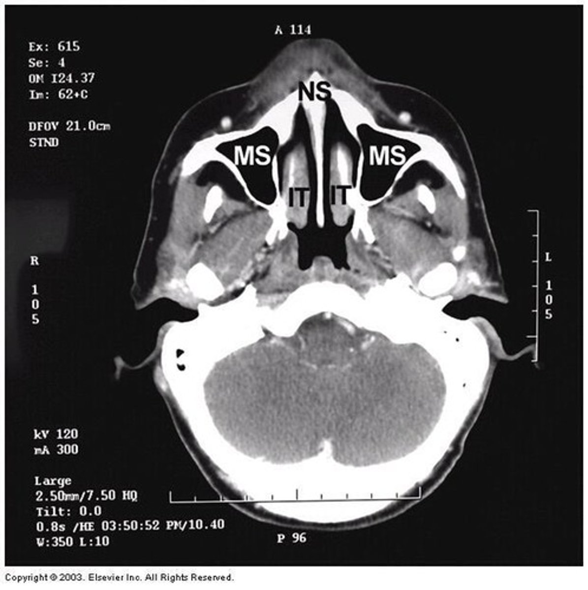 <p>Three bony structures that increase the surface area of the nose, create turbulent airflow, filter air, humidify inspired gases, and warm inspired gases.</p>