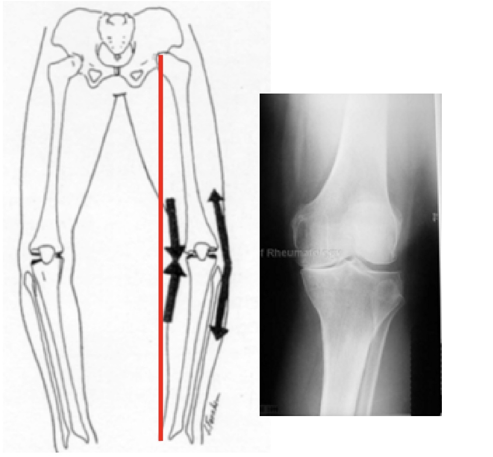 <p>What is the static alignment of this knee?</p>