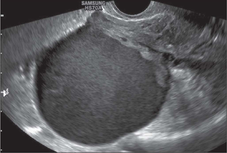 <p>“Chocolate cyst”</p><ul><li><p>heavy menses</p></li><li><p>well-defined</p></li><li><p>infertility</p></li><li><p>spotting</p></li><li><p>chronic lower back pain</p></li></ul><p></p>