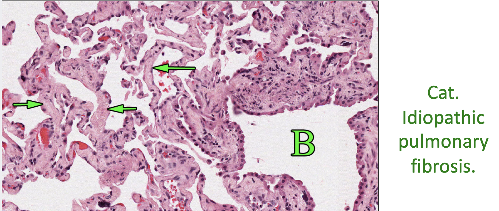 Alveolar Injury and Restrictive Lung Disease

* Obstruct oxygen exchange in alveoli
* Reduce pulmonary _____________ — stiff & inelastic
* Reduce lung capacity — reduced ____________